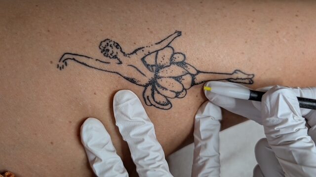 tattoo verwijderen elektrolysestudio